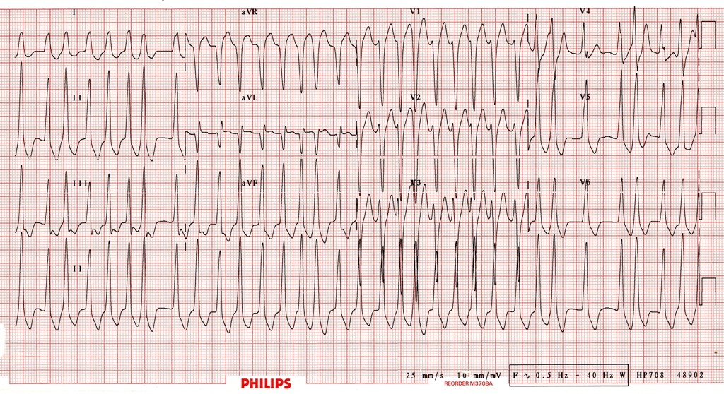 atrial fibrillation