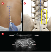Lumbar Puncture, Ultrasound guided fracture reduction | EM Cases