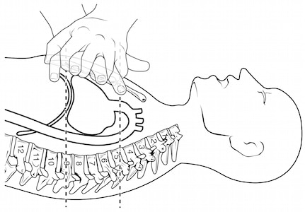 Cardiologist supports continuous chest compression CPR