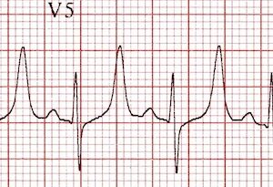 emergency management of hyperkalemia