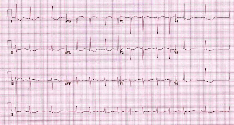 digoxin-effect - Emergency Medicine Cases