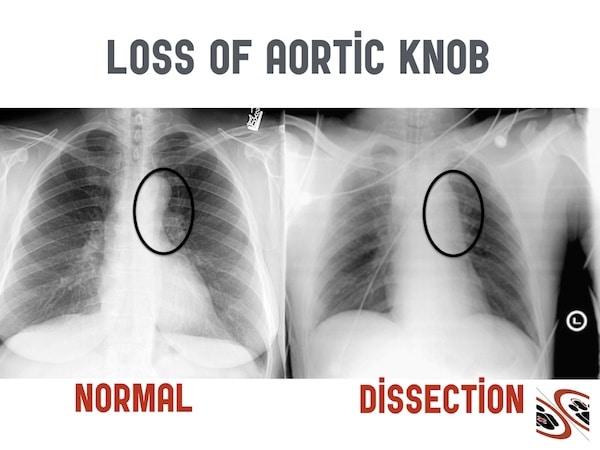 aortic dissection x ray