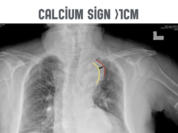 aortic dissection x ray