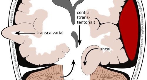pediatric cerebral herniation