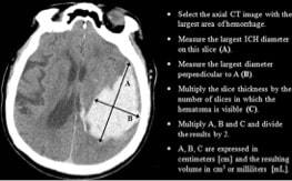 emergency management of intracerebral hemorrhage