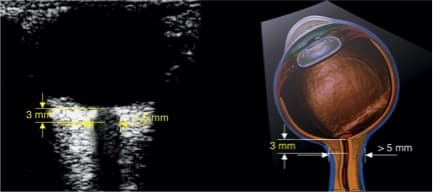 emergency management of intracerebral hemorrhage