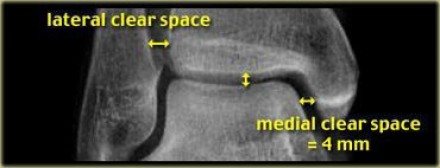 commonly missed ankle injuries 