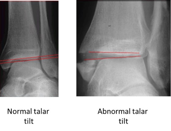 Ankle Orthopaedic Test: Talar tilt