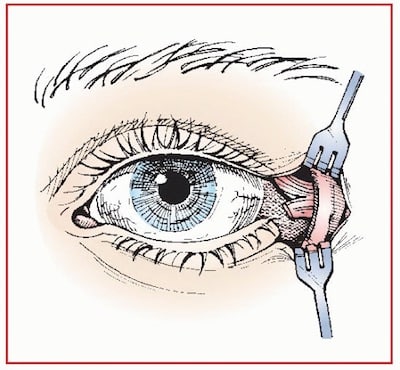 lateral canthotomy