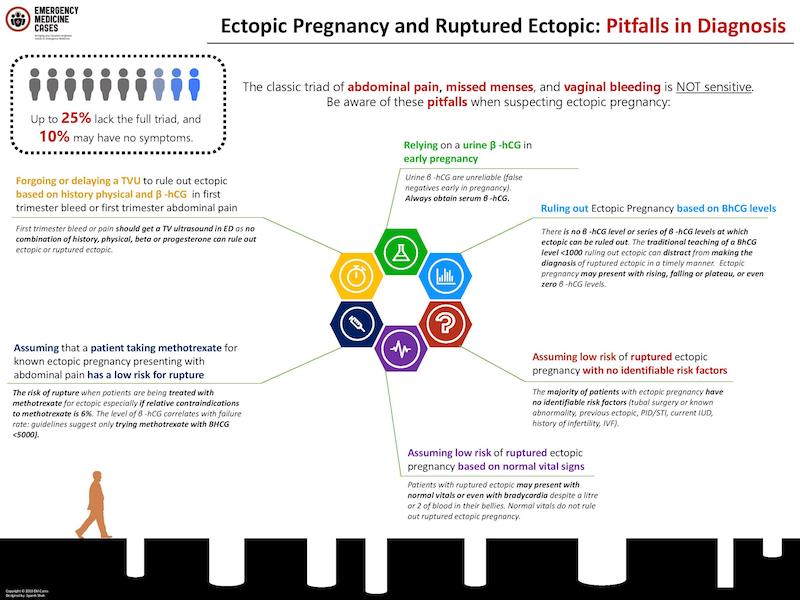 Ectopic Pregnancy