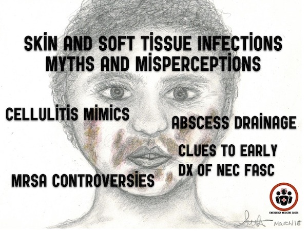 Skin And Soft Tissue Infections Emergency Medicine Cases Em Cases