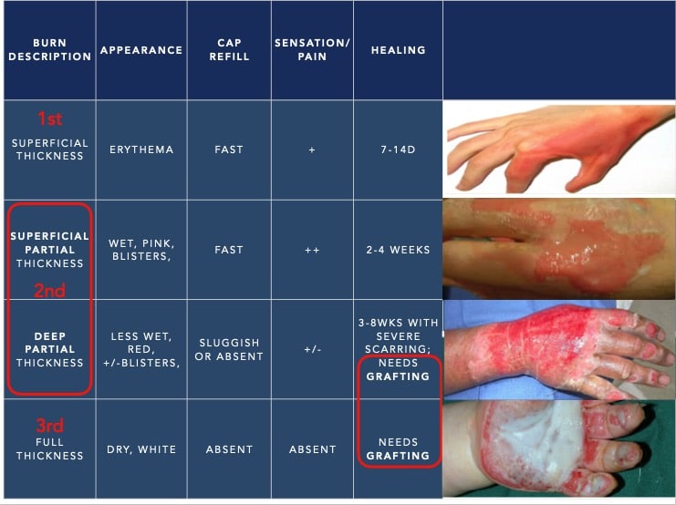 burn and inhalation injuries