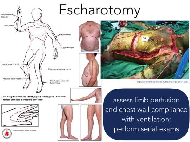 Burn and Inhalation Injury: ED Wound Care, Resuscitation & Airway