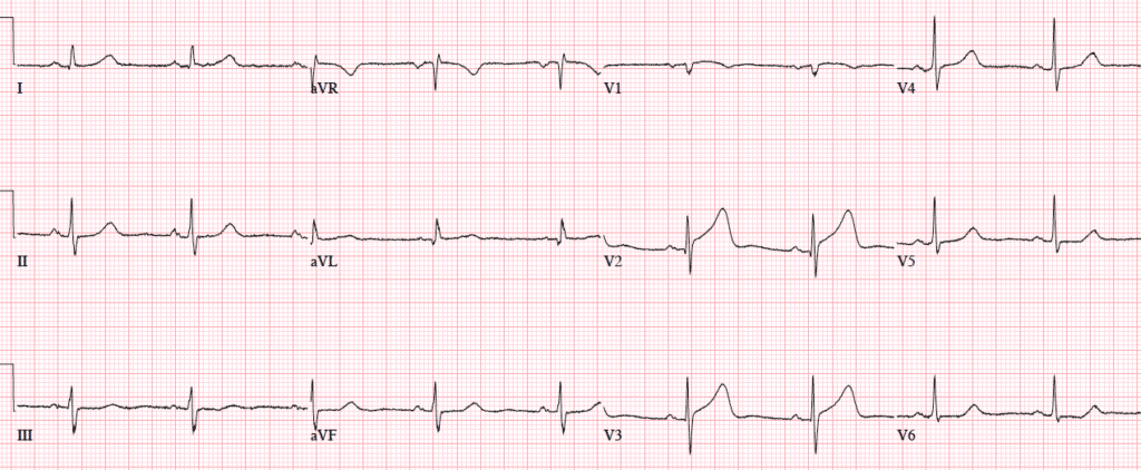 early repolarization or anterior STEMI | ECG cases | EM cases