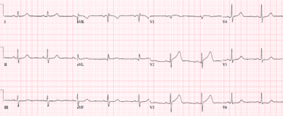 early repolarization or anterior STEMI | ECG cases | EM cases