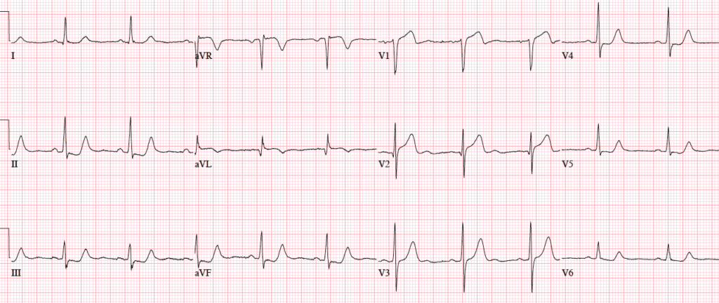 Never Trust The ECG Computer Interpretation for Ischemia | ECG Cases ...