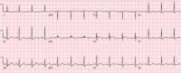 early repolarization or anterior STEMI | ECG cases | EM cases
