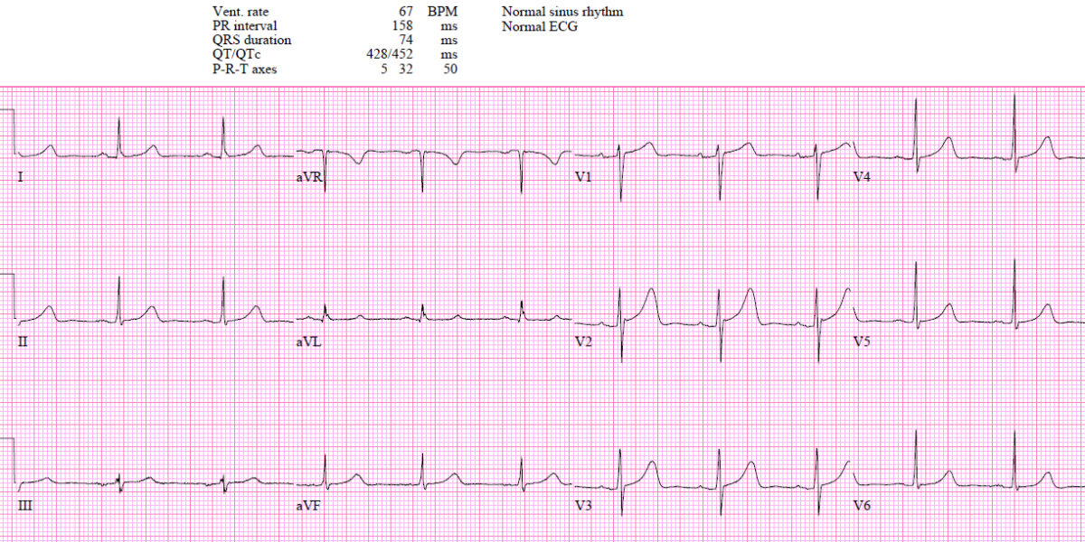 EM cases | ECG cases | First diagonal occlusion