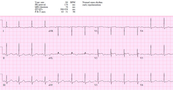EM cases | ECG cases | First diagonal occlusion