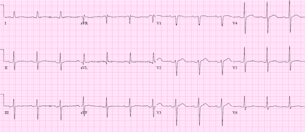 EM cases | ECG cases | First diagonal occlusion