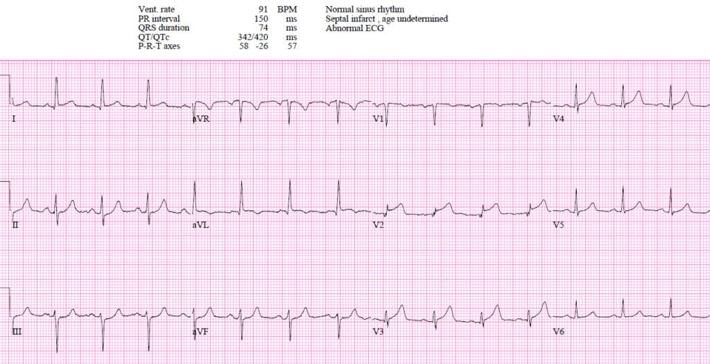 EM cases | ECG cases | First diagonal occlusion