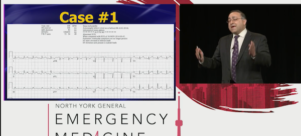 Killer ECGs Pericardial Effusions EMU365 video