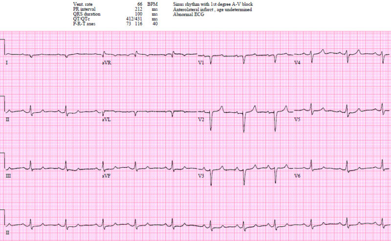 hyperkalemia ecg findings wikimedia hyperkalemia ecg findings wikimedia