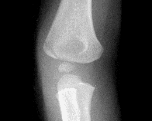 lateral epicondyl fracture