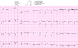 Left bundle branch block (LBBB) in acute myocardial infarction: the  Sgarbossa criteria – ECG & ECHO