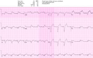 Left bundle branch block (LBBB) in acute myocardial infarction: the  Sgarbossa criteria – ECG & ECHO