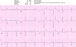 Left bundle branch block (LBBB) in acute myocardial infarction: the  Sgarbossa criteria – ECG & ECHO