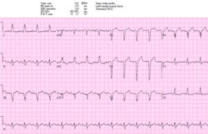 Left bundle branch block (LBBB) in acute myocardial infarction: the  Sgarbossa criteria – ECG & ECHO