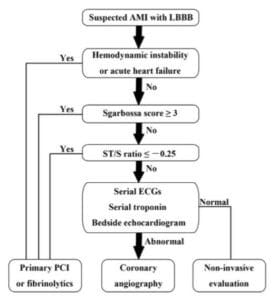 Modified Smith/Sgarbosa Criteria for occlusion MI in the setting of LBBB