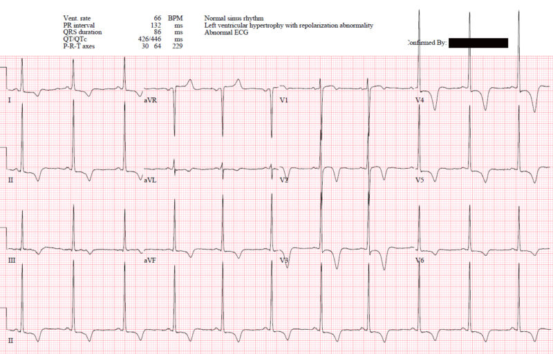 EM cases | ECG cases 13: LVH + occlusion MI