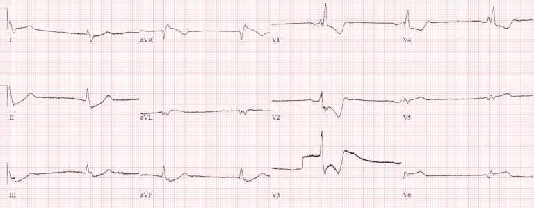 ECG Cases 15: Tall R Wave in V1 | Emergency Medicine Cases