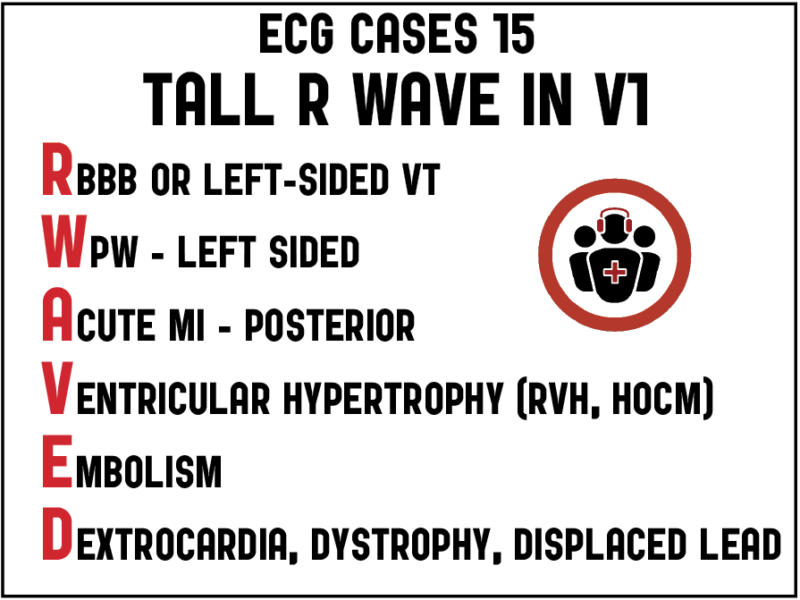 ECG Cases 15 Tall R Wave in V1 Emergency Medicine Cases