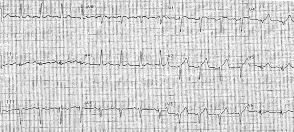 ECG Cases 16: poor R-wave progression - LATE mnemonic | ECG Cases