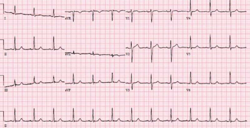 Svt Depression ST DEPRESSED mnemonic and Occlusion MI | ECG Cases | EM Cases