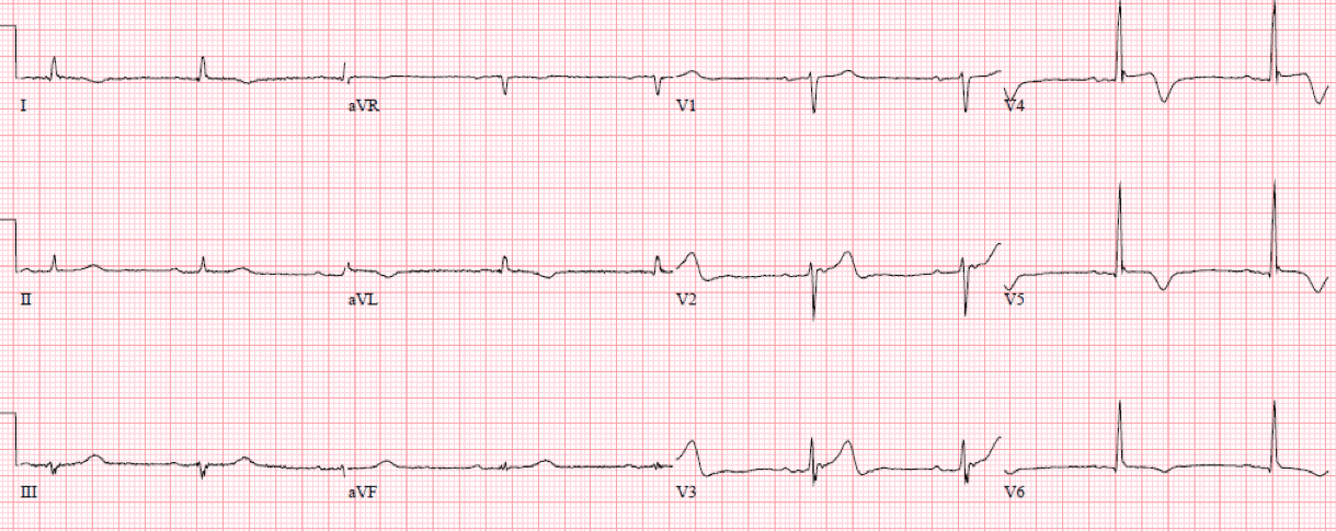 Svt Depression ST DEPRESSED mnemonic and Occlusion MI | ECG Cases | EM Cases