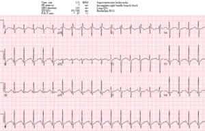 ventricular tachycardia vs supraventricular tachycardia