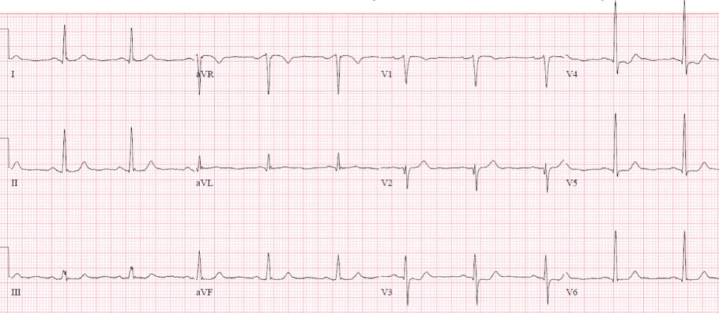 Hyperacute T waves and Occlusion MI | ECG Cases| Emergency Medicine Cases