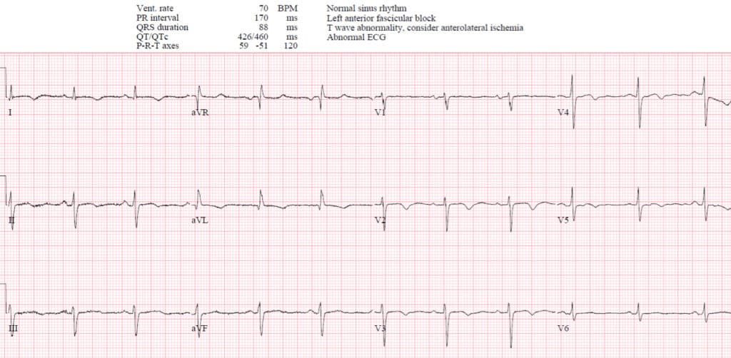 T-wave INVERSION mnemonic | ECG Cases | Emergency Medicine Cases