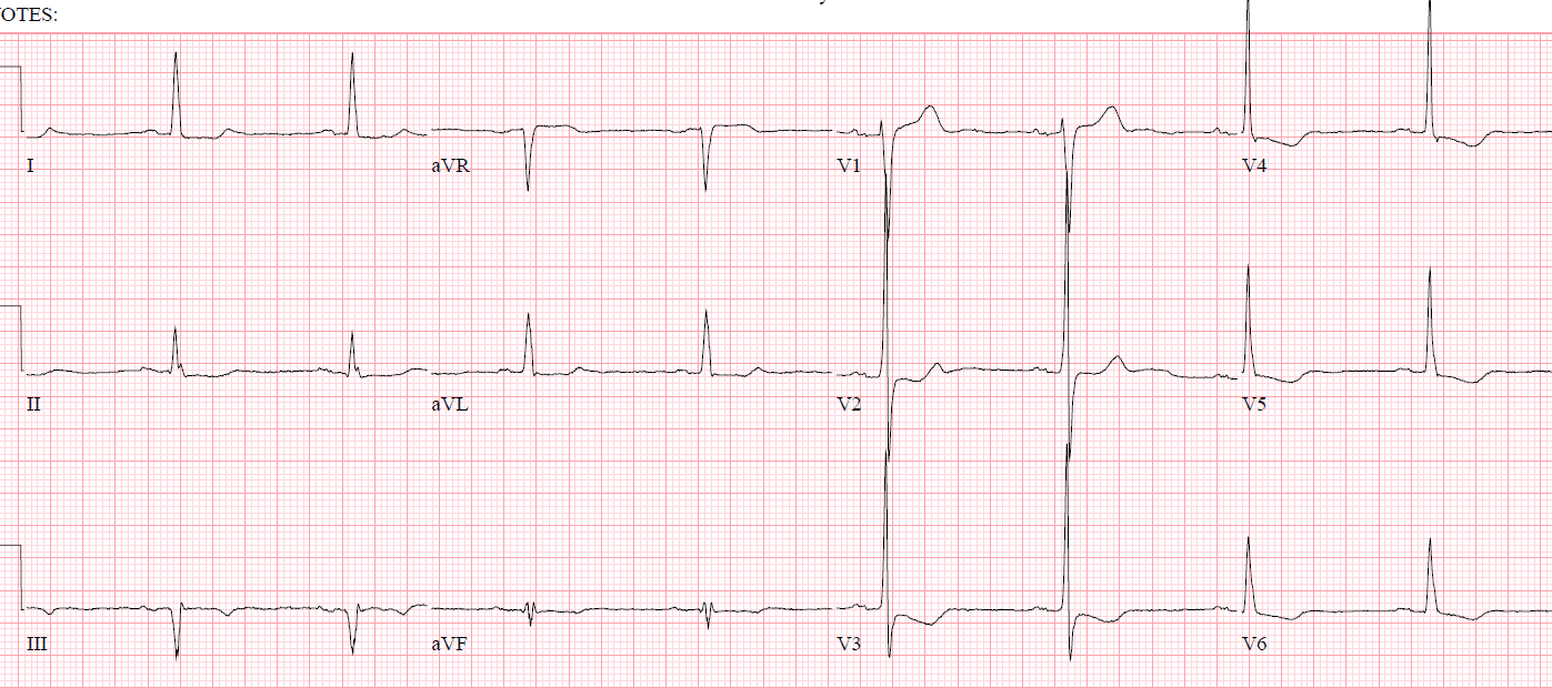 Reciprocal Changes and Occlusion MI ECG Cases Emergency Medicine Cases