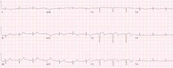 Reciprocal Changes and Occlusion MI | ECG Cases | Emergency Medicine Cases