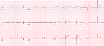 Reciprocal Changes and Occlusion MI | ECG Cases | Emergency Medicine Cases
