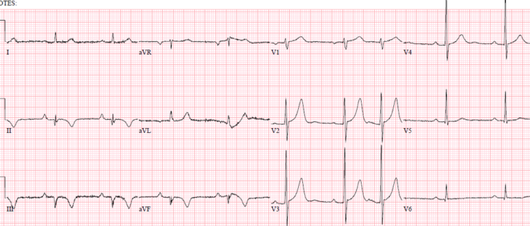 Reciprocal Changes and Occlusion MI | ECG Cases | Emergency Medicine Cases