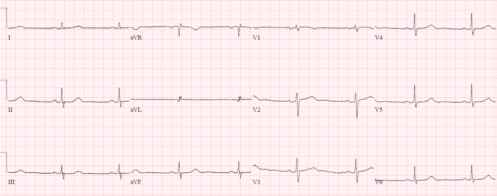 Reciprocal Changes and Occlusion MI | ECG Cases | Emergency Medicine Cases