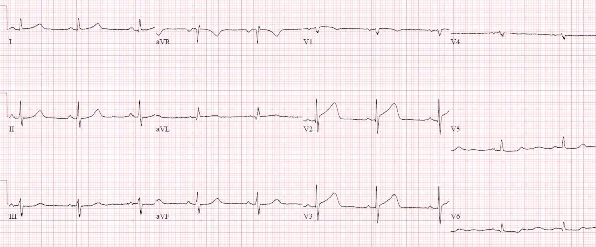 Reciprocal Changes and Occlusion MI | ECG Cases | Emergency Medicine Cases