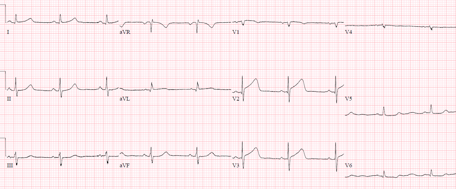 Reciprocal Changes and Occlusion MI ECG Cases Emergency Medicine Cases