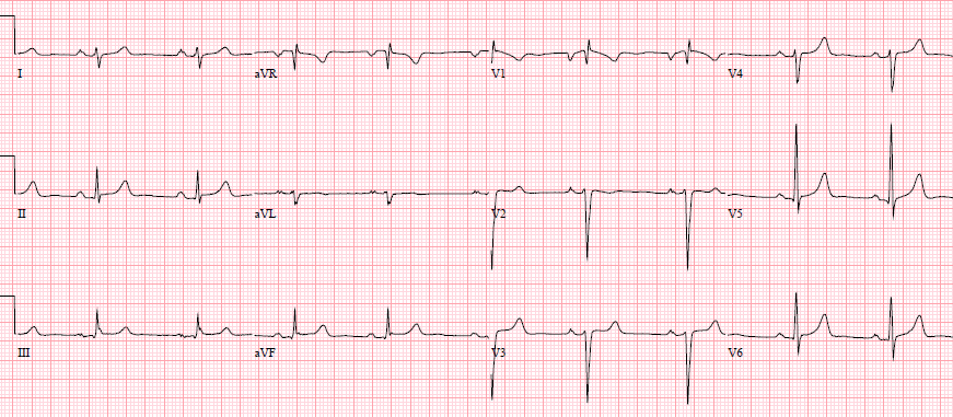 Post Rosc Mi Ecg Reciprocal Changes and Occlusion MI | ECG Cases | Emergency Medicine Cases